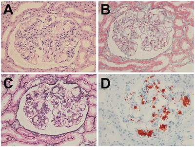 Case Report: A Pediatric Case of Lipoprotein Glomerulopathy in China and Literature Review